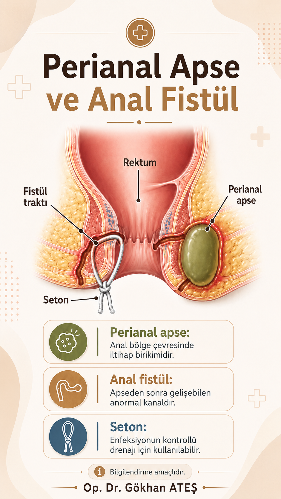 Anal apse, anal fistül traktı ve seton uygulaması anatomik infografik gösterimi